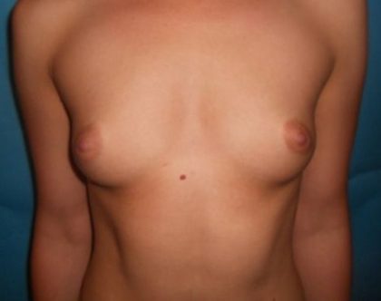 Breast Augmentation Before & After Patient #20863