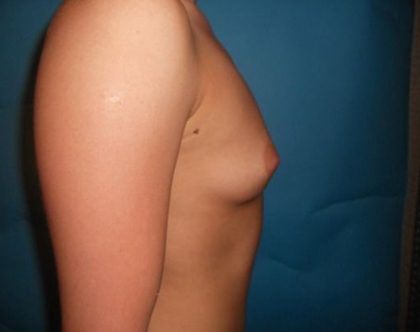 Breast Augmentation Before & After Patient #20863