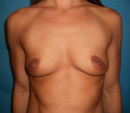 Breast Augmentation Before & After Patient #20864