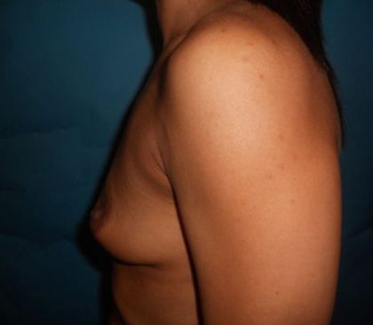 Breast Augmentation Before & After Patient #20864
