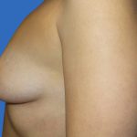 Breast Augmentation Before & After Patient #20868