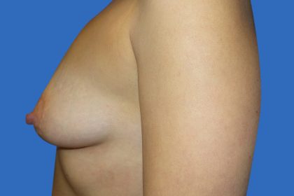 Breast Augmentation Before & After Patient #20868