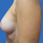 Breast Augmentation Before & After Patient #20868