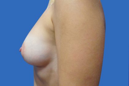 Breast Augmentation Before & After Patient #20868