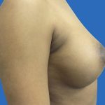 Breast Augmentation Before & After Patient #20869