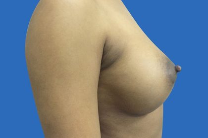 Breast Augmentation Before & After Patient #20869