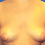 Breast Augmentation Before & After Patient #20870