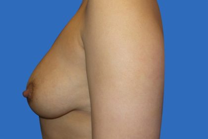 Breast Augmentation Before & After Patient #20871