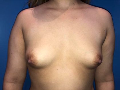 Breast Augmentation Before & After Patient #20941