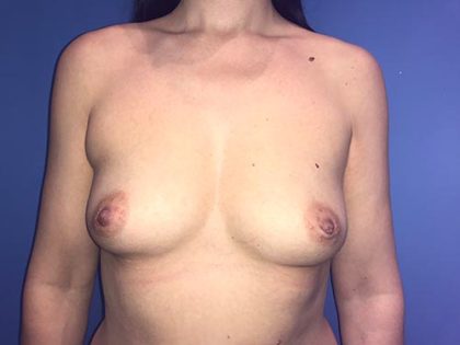 Breast Augmentation Before & After Patient #20889