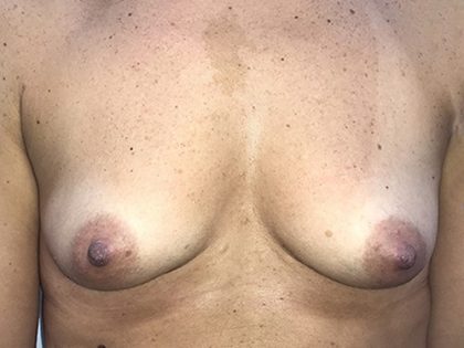 Breast Augmentation Before & After Patient #20890