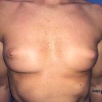 Breast Augmentation Before & After Patient #20893