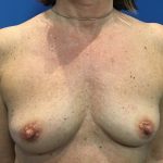 Breast Augmentation Before & After Patient #20894