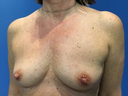 Breast Augmentation Before & After Patient #20894