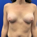 Breast Augmentation Before & After Patient #20896