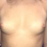 Breast Augmentation Before & After Patient #20900