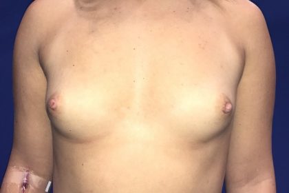 Breast Augmentation Before & After Patient #20900