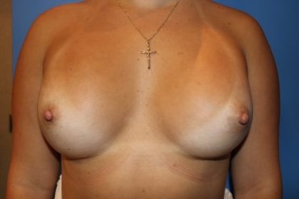 Breast Augmentation Before & After Patient #20900