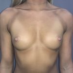 Breast Augmentation Before & After Patient #20902