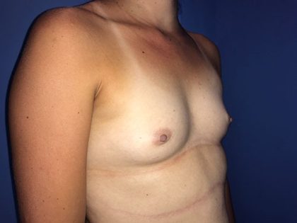 Breast Augmentation Before & After Patient #20903