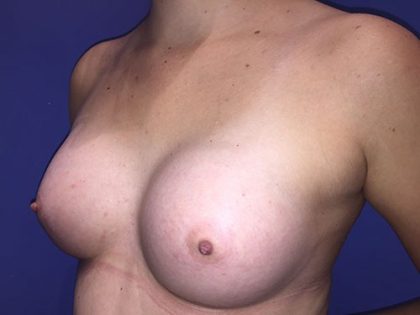 Breast Augmentation Before & After Patient #20903