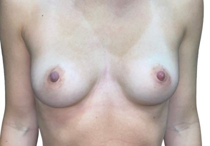 Breast Augmentation Before & After Patient #20908