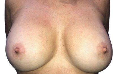 Breast Augmentation Before & After Patient #20909