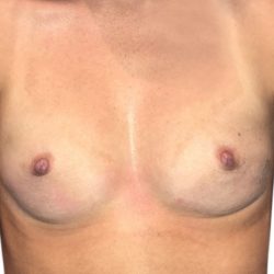 Breast Augmentation Before & After Patient #20958