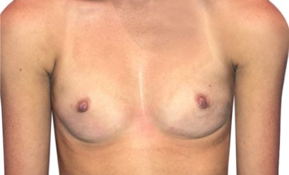 Breast Augmentation Before & After Patient #20958