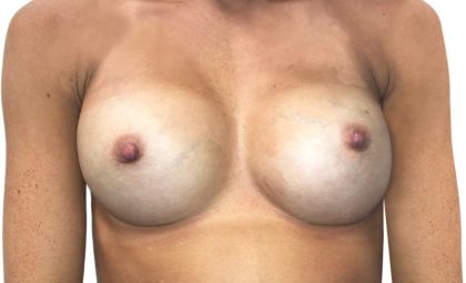 Breast Augmentation Before & After Patient #20958