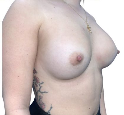 Breast Augmentation Before & After Patient #20962