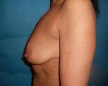 Breast Lift Before & After Patient #21001