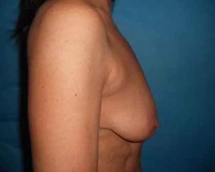 Breast Lift Before & After Patient #21001