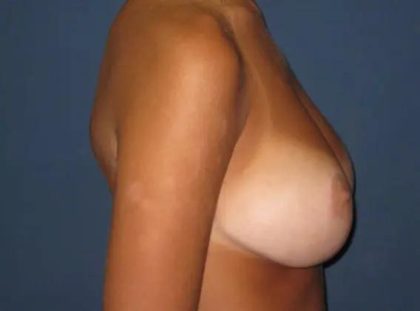 Breast Lift Before & After Patient #21002