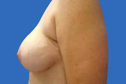 Breast Lift Before & After Patient #21003