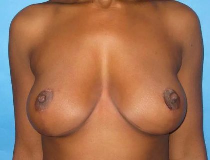 Breast Lift Before & After Patient #21004