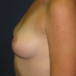 Breast Lift Before & After Patient #21005
