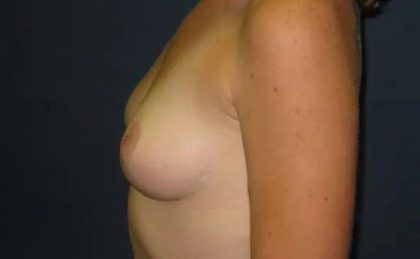 Breast Lift Before & After Patient #21005