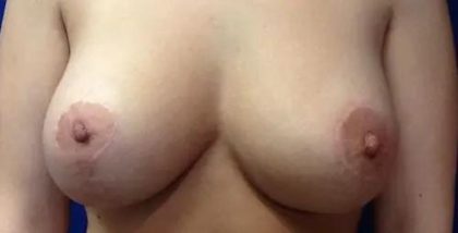 Breast Lift Before & After Patient #21006