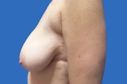 Breast Lift Before & After Patient #21009