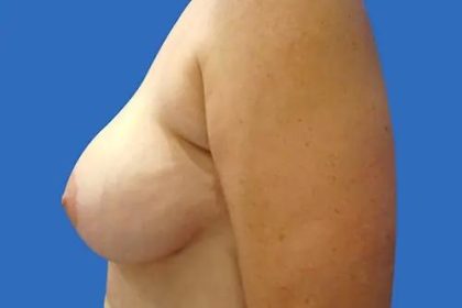 Breast Lift Before & After Patient #21009