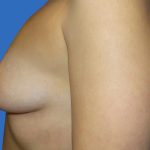 Breast Lift Before & After Patient #21010