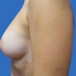 Breast Lift Before & After Patient #21010