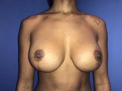Breast Lift Before & After Patient #21011