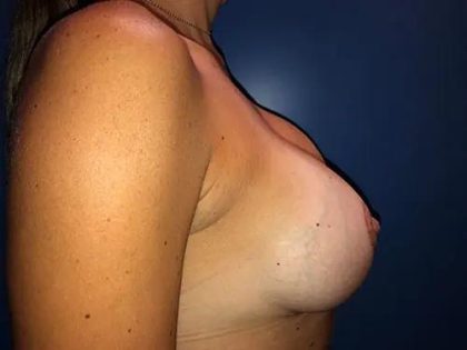 Breast Lift Before & After Patient #21013