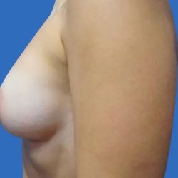 Breast Lift Before & After Patient #21014