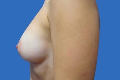 Breast Lift Before & After Patient #21014