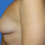 Breast Lift Before & After Patient #21016