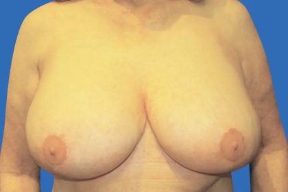 Breast Lift Before & After Patient #21019