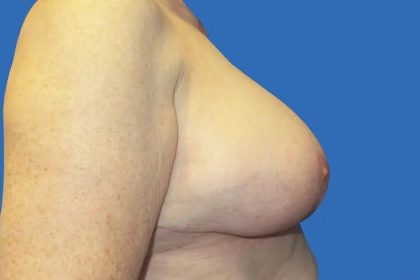 Breast Lift Before & After Patient #21019